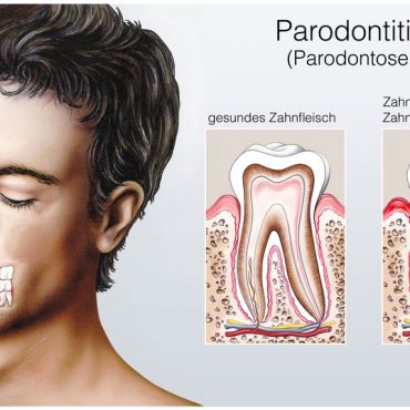 Parodontitisbehandlung