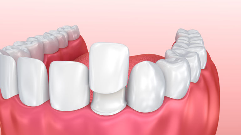 Veneers