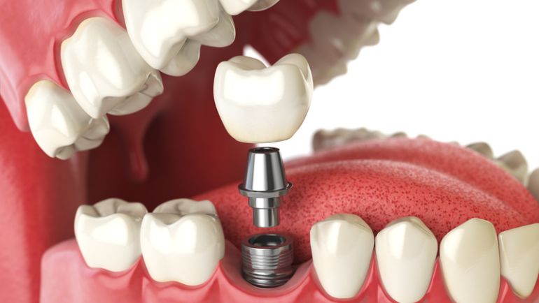 Implantate